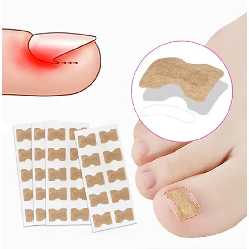 CalmaPro™: Parche para uñas encarnadas
