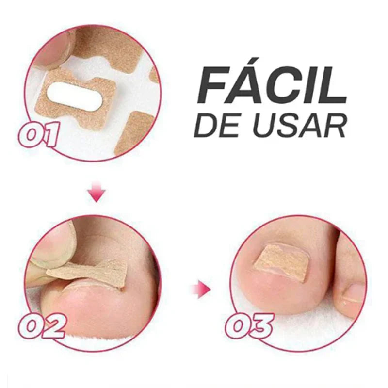 CalmaPro™: Parche para uñas encarnadas