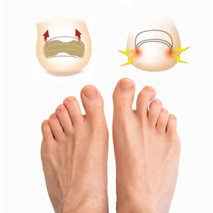 CalmaPro™: Parche para uñas encarnadas