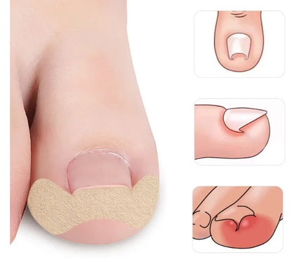CalmaPro™: Parche para uñas encarnadas