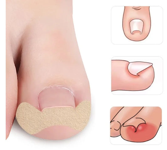 CalmaPro™: Parche para uñas encarnadas
